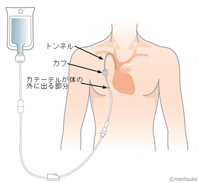 PICCとは／輸液治療に用いる医療機器について11