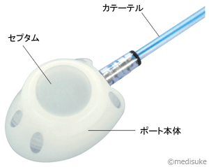 Piccとは 輸液治療に用いる医療機器について Infusion Medisuke