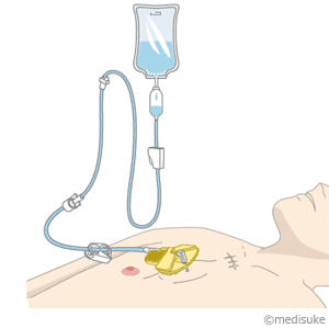 PICCとは／輸液治療に用いる医療機器について13