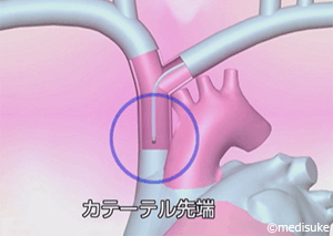 PICCとは／輸液治療に用いる医療機器について18