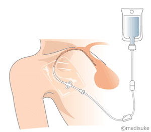 PICCとは／輸液治療に用いる医療機器について2