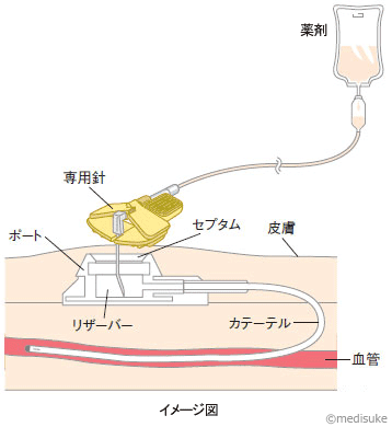 PICCとは／輸液治療に用いる医療機器について21