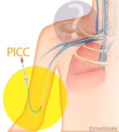 PICCとは／輸液治療に用いる医療機器について3