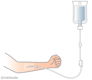 PICCとは／輸液治療に用いる医療機器について7