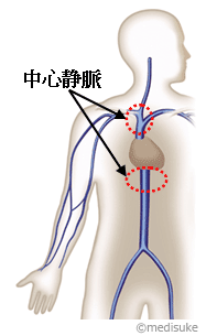 PICCとは／輸液治療に用いる医療機器について8