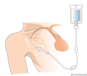 Piccとは 輸液治療に用いる医療機器について Infusion Medisuke