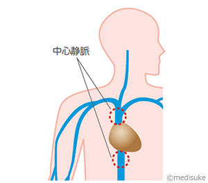 あなたの血管ガマンしていませんか？（PICC編)7