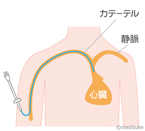 あなたの血管ガマンしていませんか？（PICC編)9